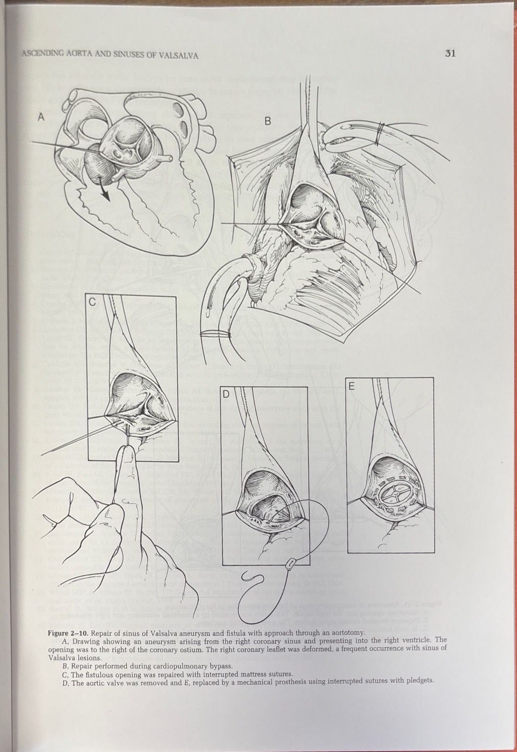 Surgical treatment of aortic aneurysms