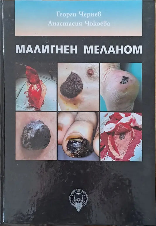 Малигнен меланом - Книги