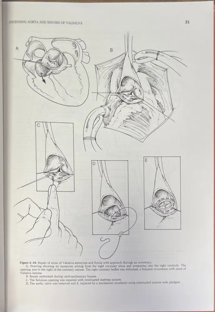 Surgical treatment of aortic aneurysms - Книги